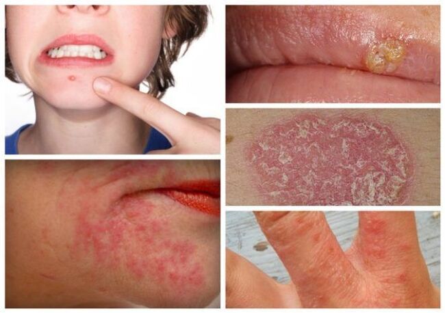 Аллергия жана тери оорулары организмдеги мите курттардын белгиси