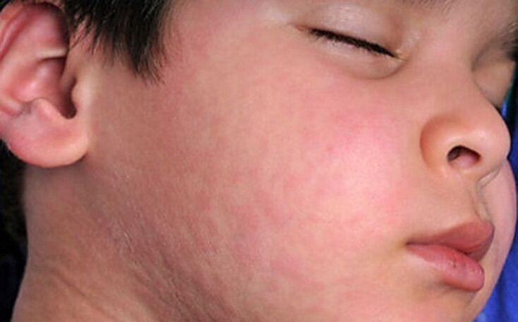 Теридеги аллергиялык исиркектер - организмде мите курттардын болушунун белгиси